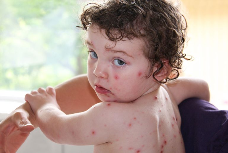 دکتر سندرم ری در کودکان - اصفهان